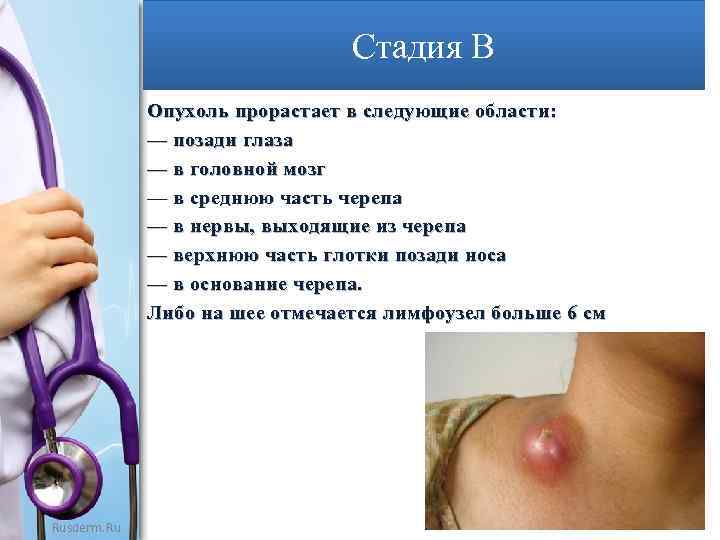 Стадия В Oпухоль прорастает в следующие области: — позади глаза — в головной мозг