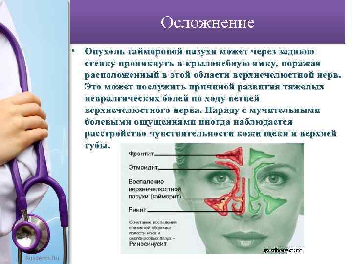 Осложнение • Опухоль гайморовой пазухи может через заднюю стенку проникнуть в крылонебную ямку, поражая