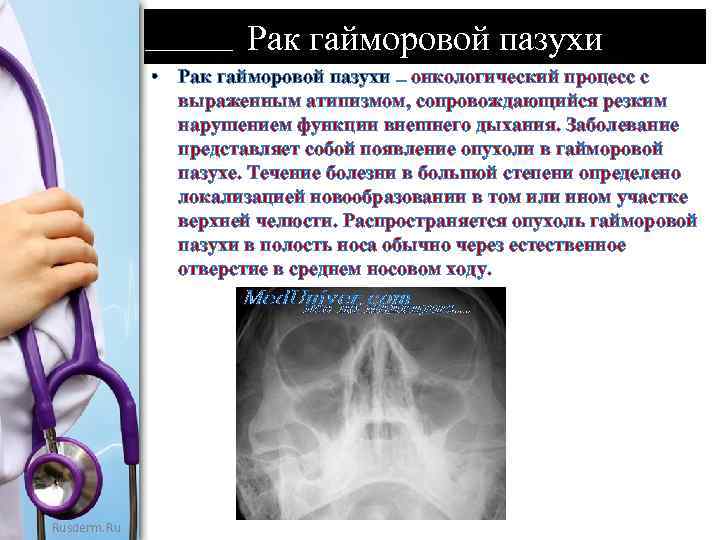 Рак гайморовой пазухи • Рак гайморовой пазухи онкологический процесс с выраженным атипизмом, сопровождающийся резким