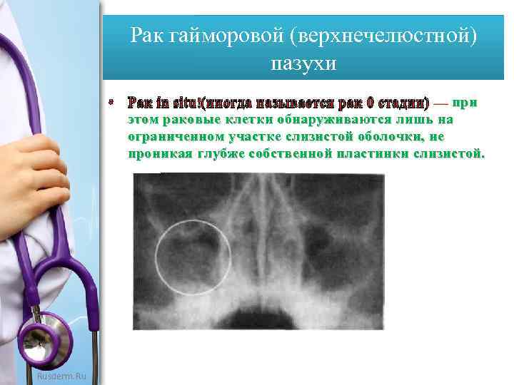 Рак гайморовой (верхнечелюстной) пазухи при • Рак in situ (иногда называется рак 0 стадии)