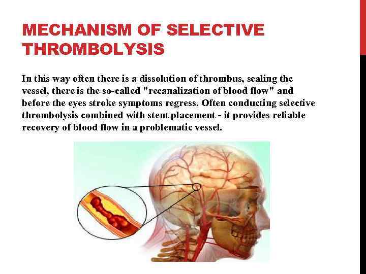 MECHANISM OF SELECTIVE THROMBOLYSIS In this way often there is a dissolution of thrombus,