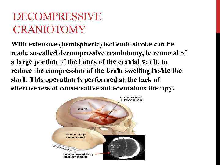 DECOMPRESSIVE CRANIOTOMY With extensive (hemispheric) ischemic stroke can be made so-called decompressive craniotomy, ie