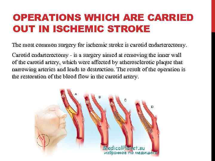OPERATIONS WHICH ARE CARRIED OUT IN ISCHEMIC STROKE The most common surgery for ischemic