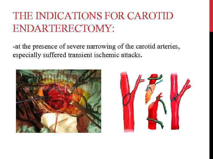 THE INDICATIONS FOR CAROTID ENDARTERECTOMY: -at the presence of severe narrowing of the carotid