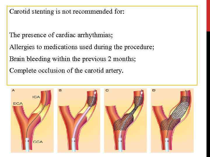 Carotid stenting is not recommended for: The presence of cardiac arrhythmias; Allergies to medications