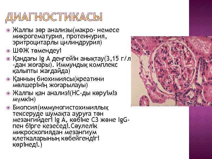  Жалпы зәр анализы(макро- немесе микрогематурия, протеинурия, эритроцитарлы цилиндрурия) ШФЖ төмендеуі Қандағы Ig А