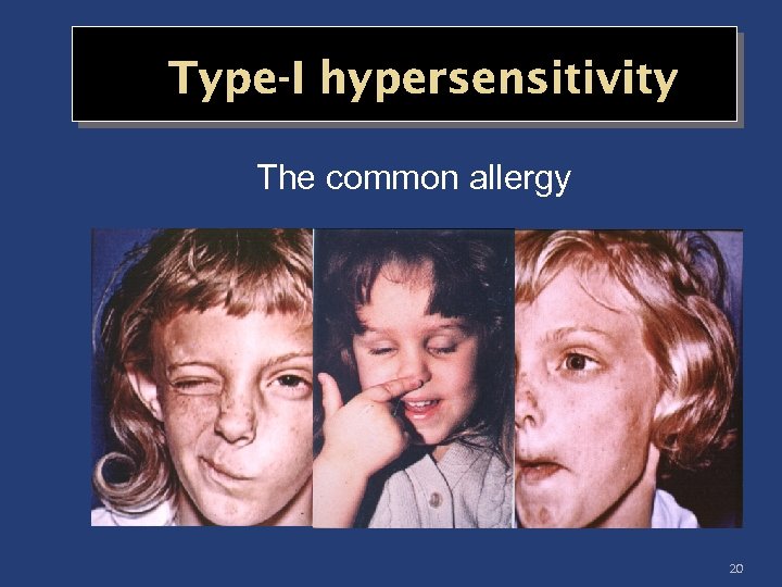 Type-I hypersensitivity The common allergy 20 