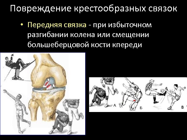 Повреждение крестообразных связок • Передняя связка - при избыточном разгибании колена или смещении большеберцовой
