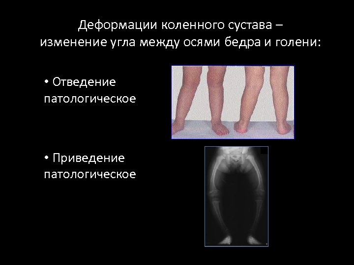 Деформации коленного сустава – изменение угла между осями бедра и голени: • Отведение патологическое