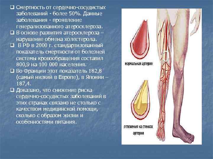 q Смертность от сердечно-сосудистых заболеваний - более 50%. Данные заболевания - проявление генерализованного атеросклероза.
