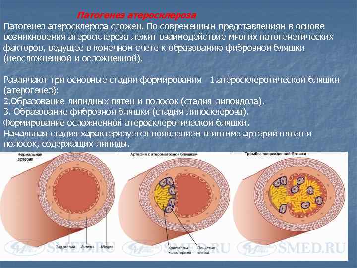 Теории развития атеросклероза. Патогенез атеросклероза патофизиология. Механизм развития атеросклероза. Патогенез атеросклеротической бляшки. Патогенез атеросклероза схема.