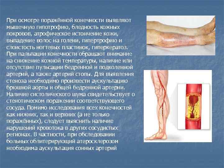 При осмотре поражённой конечности выявляют мышечную гипотрофию, бледность кожных покровов, атрофическое истончение кожи, выпадение