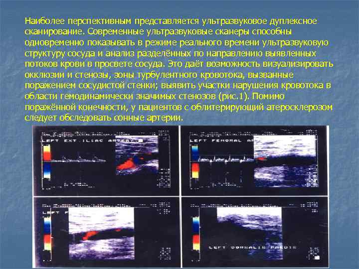 Наиболее перспективным представляется ультразвуковое дуплексное сканирование. Современные ультразвуковые сканеры способны одновременно показывать в режиме