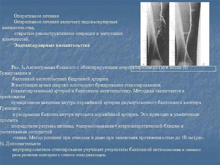 Оперативное лечение включает эндоваскулярные вмешательства, открытые реконструктивные операции и ампутации конечностей. Эндоваскулярные вмешательства Рис.