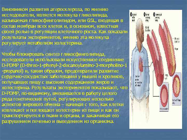 Виновником развития атеросклероза, по мнению исследователи, является молекула гликолипида, называемая гликосфинголипидом, или GSL, входящая