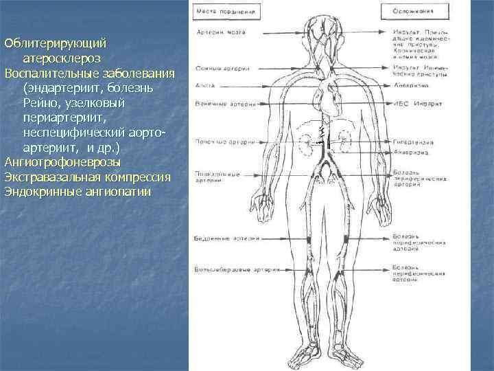 Облитерирующий атеросклероз Воспалительные заболевания (эндартериит, болезнь Рейно, узелковый периартериит, неспецифический аортоартериит, и др. )