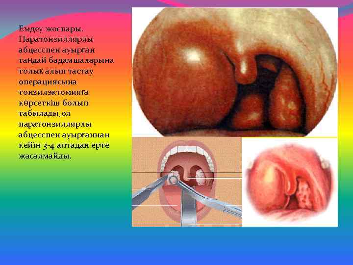 Емдеу жоспары. Паратонзиллярлы абцесспен ауырған таңдай бадамшаларына толық алып тастау операциясына тонзилэктомияға көрсеткіш болып
