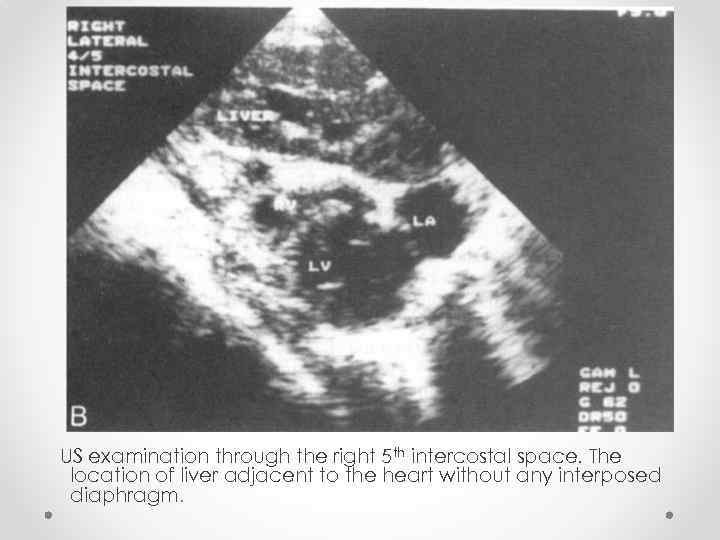 US examination through the right 5 th intercostal space. The location of liver adjacent