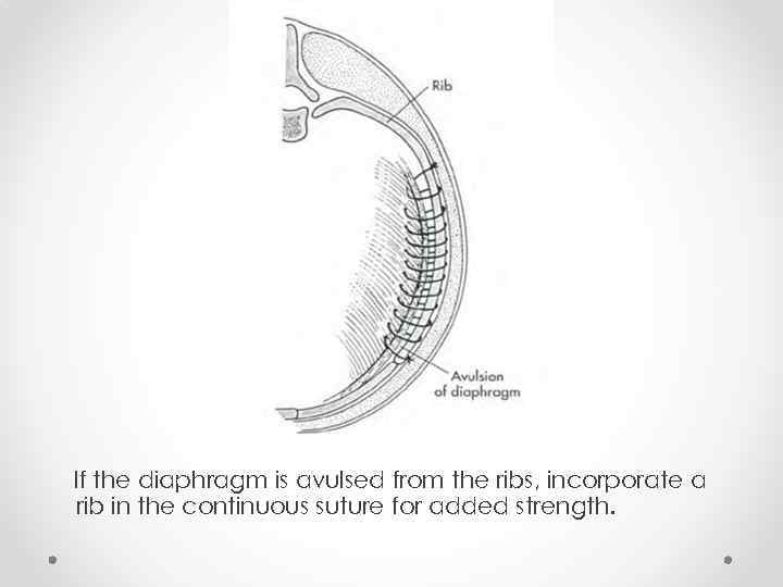 If the diaphragm is avulsed from the ribs, incorporate a rib in the continuous