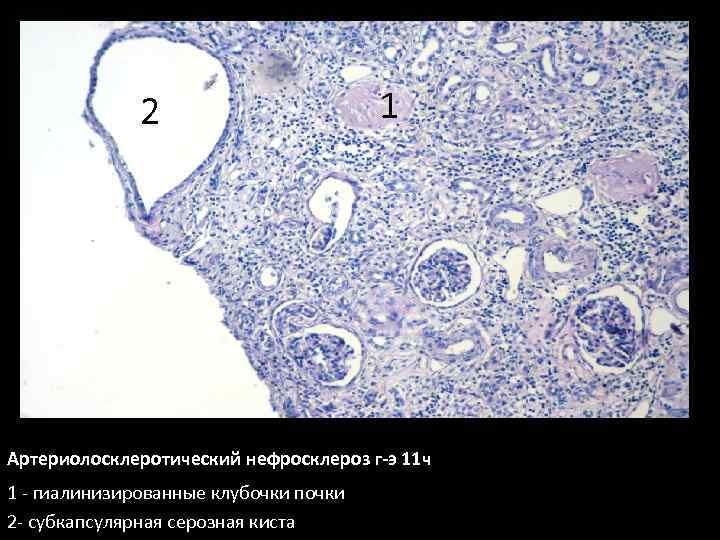 Артериолосклеротический нефросклероз микропрепарат рисунок