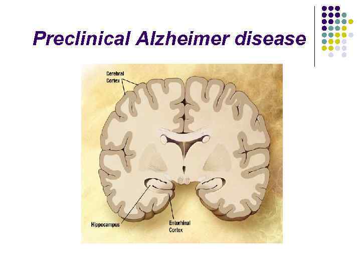Preclinical Alzheimer disease 