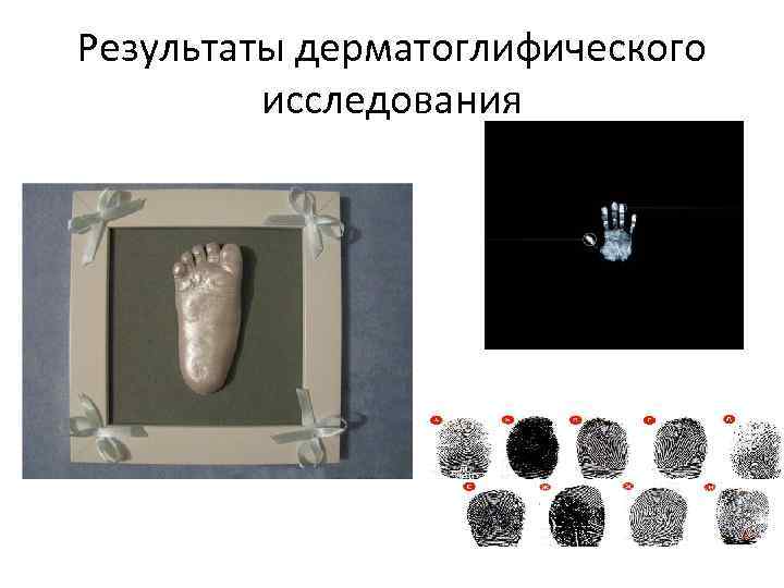 Результаты дерматоглифического исследования 