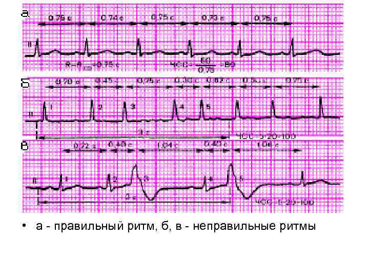  • а - правильный ритм, б, в - неправильные ритмы 
