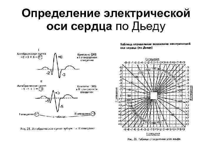 Диаграмма дьеда экг