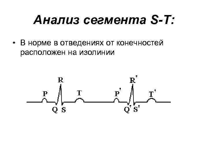 Анализ сегмента S-T: • В норме в отведениях от конечностей расположен на изолинии 