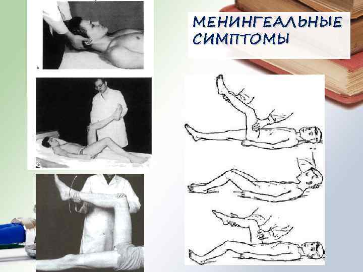 МЕНИНГЕАЛЬНЫЕ СИМПТОМЫ 