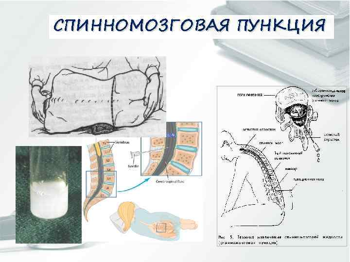 СПИННОМОЗГОВАЯ ПУНКЦИЯ 