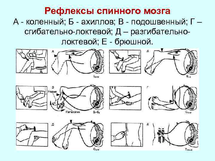 Рефлексы спинного мозга А - коленный; Б - ахиллов; В - подошвенный; Г –