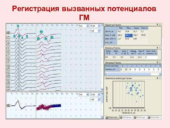 Регистрация вызванных потенциалов ГМ 