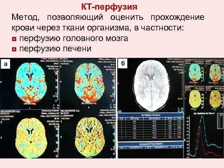 Метод позволяющий. Показатели кт перфузии головного мозга. Кт перфузия головного мозга. Перфузия головного мозга методика. Мрт перфузия головного мозга методика.