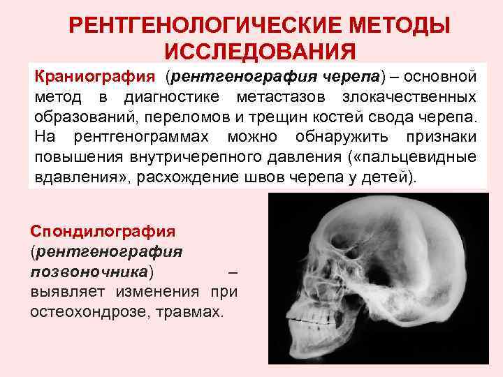 РЕНТГЕНОЛОГИЧЕСКИЕ МЕТОДЫ ИССЛЕДОВАНИЯ Краниография (рентгенография черепа) – основной метод в диагностике метастазов злокачественных образований,