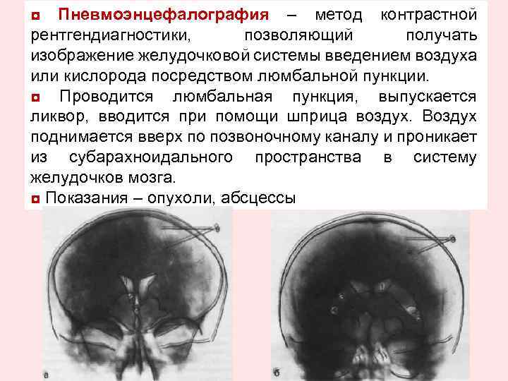 ◘ Пневмоэнцефалография – метод контрастной рентгендиагностики, позволяющий получать изображение желудочковой системы введением воздуха или