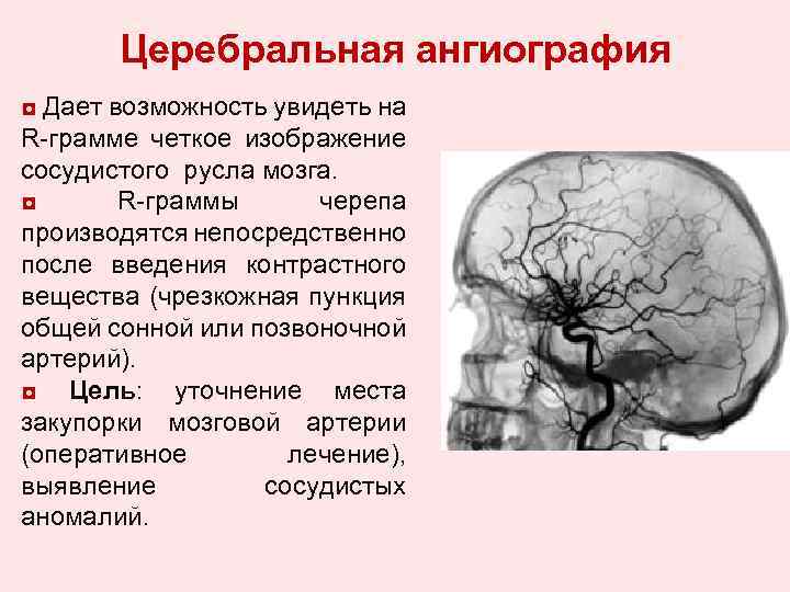 Церебральная ангиография ◘ Дает возможность увидеть на R-грамме четкое изображение сосудистого русла мозга. ◘