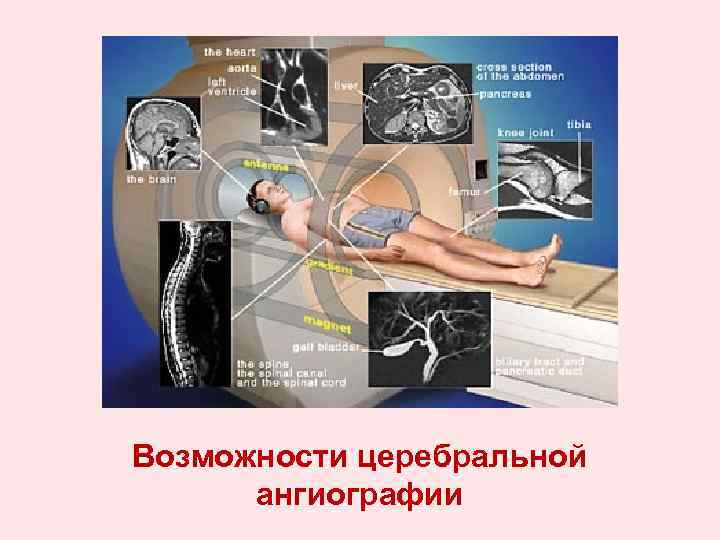 Возможности церебральной ангиографии 