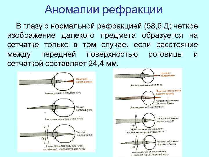 Аномалии рефракции В глазу с нормальной рефракцией (58, 6 Д) четкое изображение далекого предмета