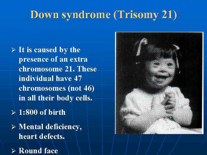 Down syndrome (Trisomy 21) Ø It is caused by the presence of an extra