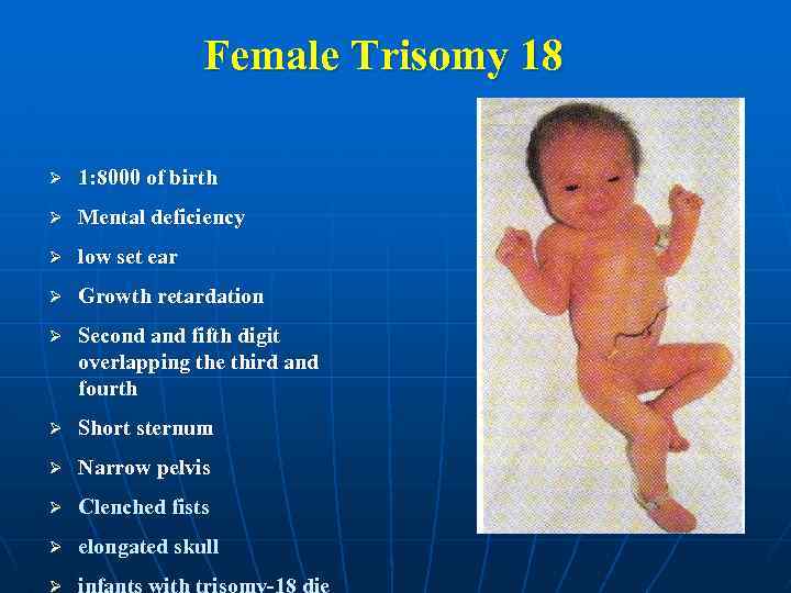 Female Trisomy 18 Ø 1: 8000 of birth Ø Mental deficiency Ø low set