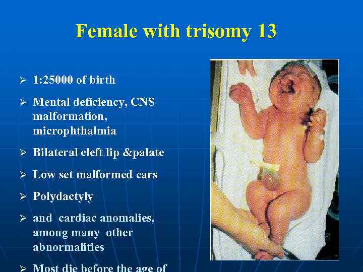 Female with trisomy 13 Ø 1: 25000 of birth Ø Mental deficiency, CNS malformation,