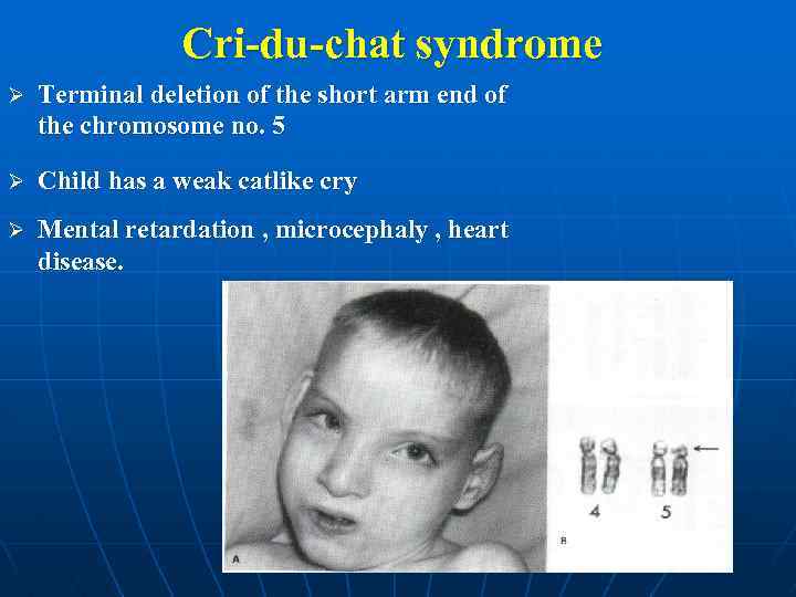 Cri-du-chat syndrome Ø Terminal deletion of the short arm end of the chromosome no.