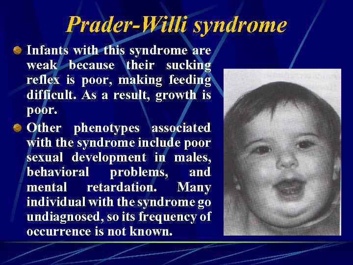 Prader-Willi syndrome Infants with this syndrome are weak because their sucking reflex is poor,