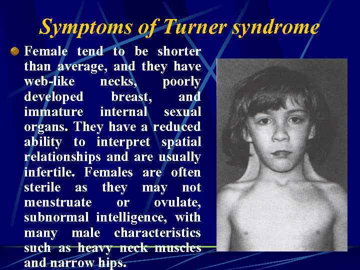 Symptoms of Turner syndrome Female tend to be shorter than average, and they have