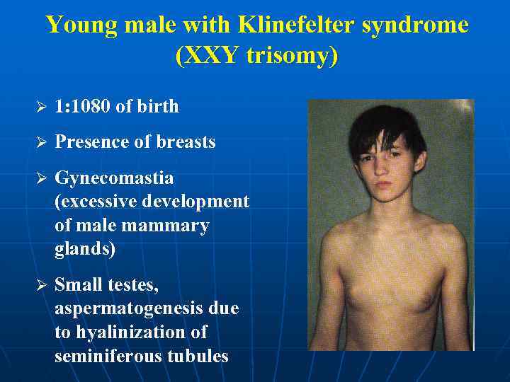 Young male with Klinefelter syndrome (XXY trisomy) Ø 1: 1080 of birth Ø Presence