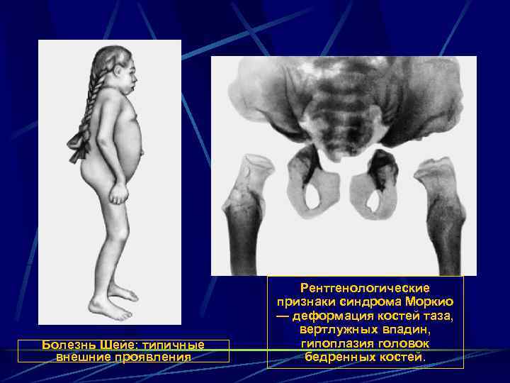 Болезнь Шейе: типичные внешние проявления Рентгенологические признаки синдрома Моркио — деформация костей таза, вертлужных