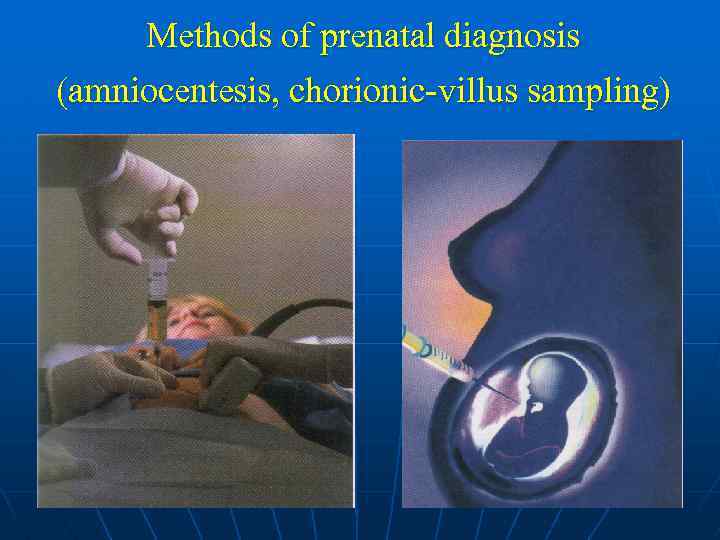 Methods of prenatal diagnosis (amniocentesis, chorionic-villus sampling) 