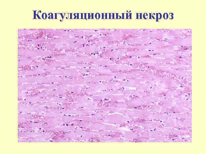 Коагуляционный и колликвационный некроз