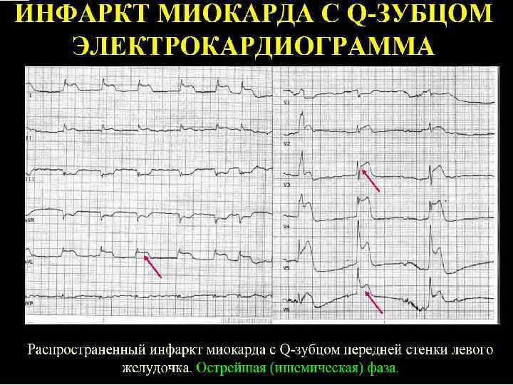 Трансмуральный инфаркт миокарда. Трансмуральный инфаркт на ЭКГ. Трансмуральный инфаркт передней стенки ЭКГ. Трансмуральный инфаркт миокарда на ЭКГ. Трансмуральная ишемия на ЭКГ.